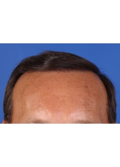 After Hair Transplant&nbsp;Front